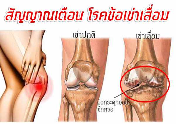 สัญญาณเตีอนโรคข้อเสื่อม